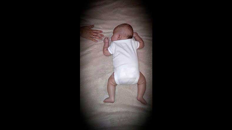 Tortícolis muscular congénita en bebé